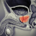 HoLEP Hangi Tip Prostat Vakaları İçin Uygundur?